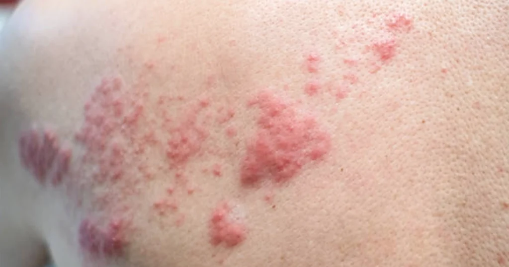 Heat rash symptoms on sun exposed skin.