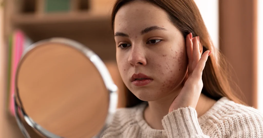 Person inspecting acne on their face in a mirror.