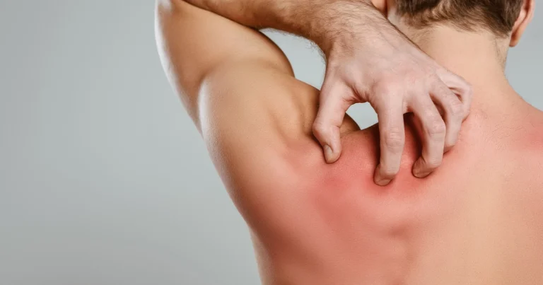 Itching sensation moving around body.